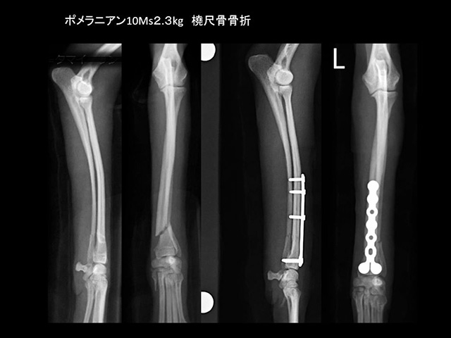 骨折